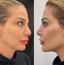 Facial Contouring before and after patient image5