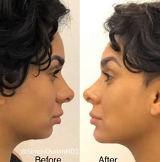 Facial Contouring before and after patient image8