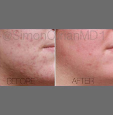 Acne scar removal before and after patient image10