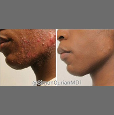 Acne scar removal before and after patient image11