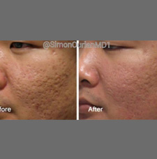 Acne scar removal before and after patient image12