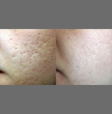 Acne scar removal before and after patient image13