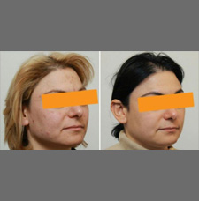 Acne scar removal before and after patient image14
