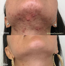 Acne scar removal before and after patient image2