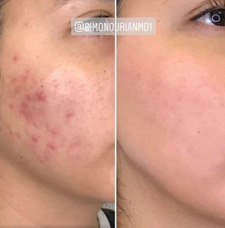 Acne scar removal before and after patient image3