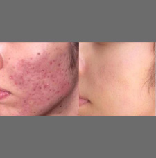 Acne scar removal before and after patient image5