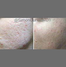 Acne scar removal before and after patient image6
