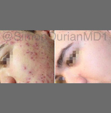 Acne scar removal before and after patient image7