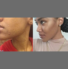 Acne scar removal before and after patient image9