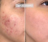 Acne Scar Removal