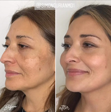 melasma before and after patient image1