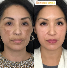 melasma before and after patient image2