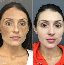 melasma before and after patient image3