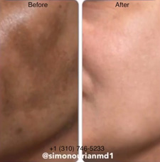 melasma before and after patient image5