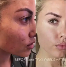 melasma before and after patient image6