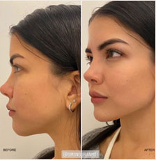 Non surgical chin augmentation image1