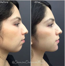 Non surgical chin augmentation image2