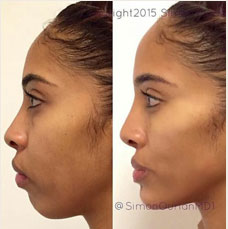 Non surgical chin augmentation image3