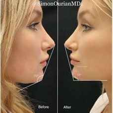 Non surgical chin augmentation image4