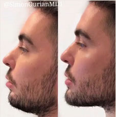 Non surgical chin augmentation image6