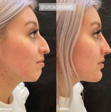 non surgical chin contouring image1