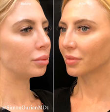 non surgical chin contouring image2