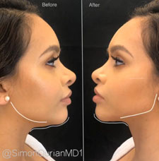 non surgical chin contouring image3