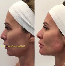 non surgical chin contouring image4