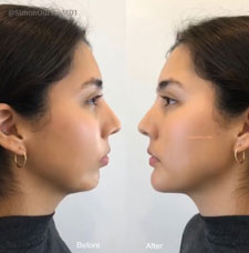 non surgical chin contouring image5