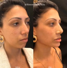 non surgical chin contouring image6