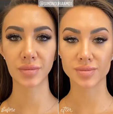non surgical chin contouring image7