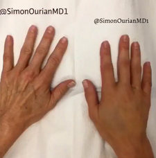 non surgical hand rejuvenation image1