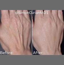 non surgical hand rejuvenation image2