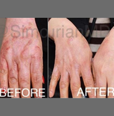 non surgical hand rejuvenation image3