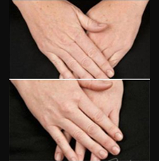 non surgical hand rejuvenation image4