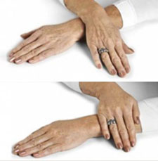 non surgical hand rejuvenation image5