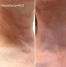 non surgical hand rejuvenation image1