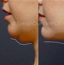 non surgical hand rejuvenation image3