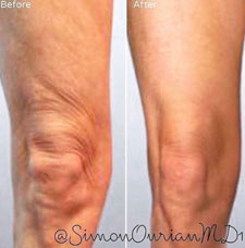 non surgical wrinkle removal image10