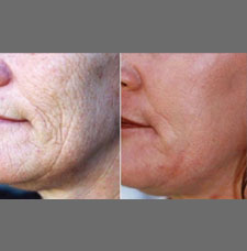 non surgical wrinkle removal image11