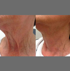 non surgical wrinkle removal image12