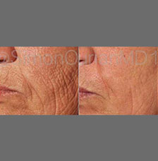 non surgical wrinkle removal image13