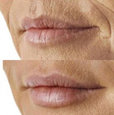 non surgical wrinkle removal image16