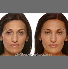 non surgical wrinkle removal image17