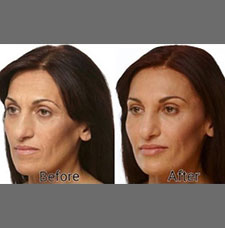 non surgical wrinkle removal image18