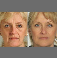 non surgical wrinkle removal image20