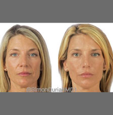 non surgical wrinkle removal image21