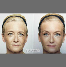 non surgical wrinkle removal image22