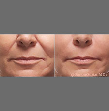 non surgical wrinkle removal image23