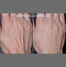 non surgical wrinkle removal image24